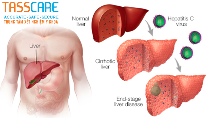 viem-gan-c-co-chua-duoc-khong