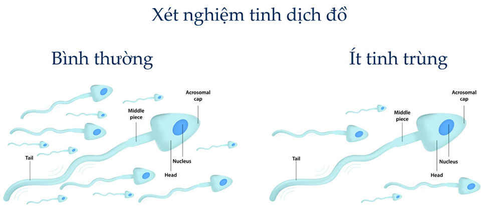 xet-nghiem-tinh-dich-do-nam
