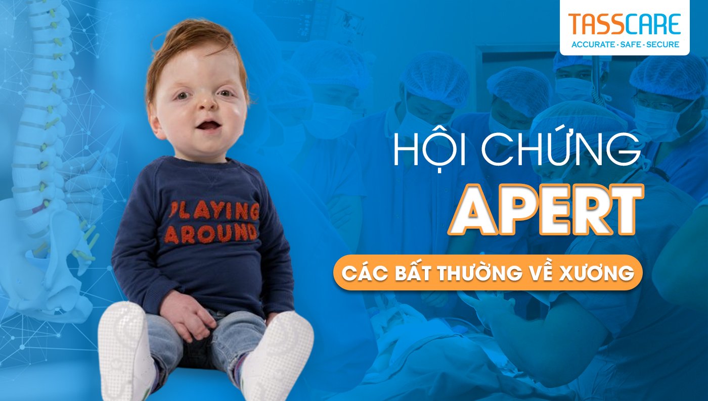 Hội chứng Apert: Các bất thường về xương