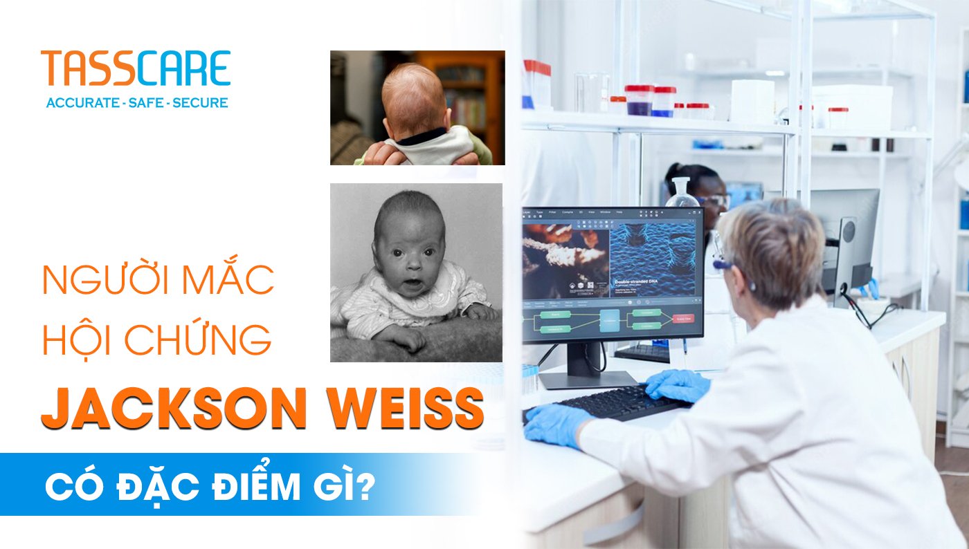 Người mắc hội chứng Jackson Weiss có đặc điểm gì?