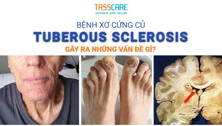 Bệnh xơ cứng củ - Tuberous sclerosis gây ra những vấn đề gì?