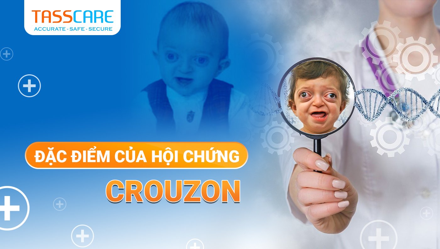 Đặc điểm của hội chứng Crouzon
